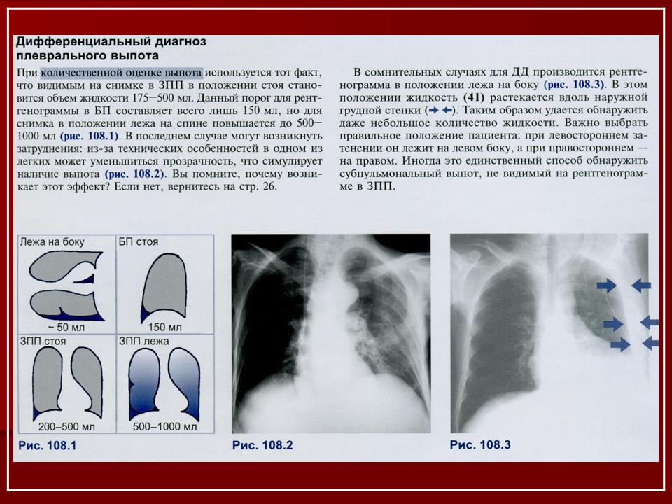 Жидкость в легких причины и лечение. Гидроторакс дифференцированная терапия. Объем жидкости в плевральной полости в норме по УЗИ. Гидроторакс классификация рентген. Выпот в плевральной полости рентген.